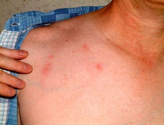 príznaky parazitov pod kožou