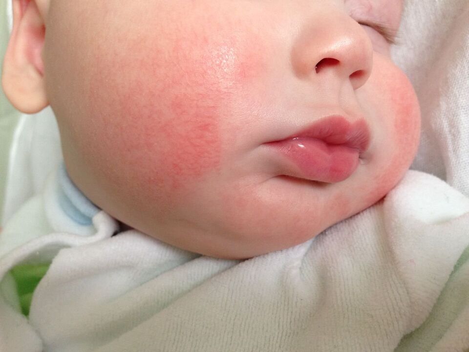 Znakom červov u dieťaťa je alergická žihľavka